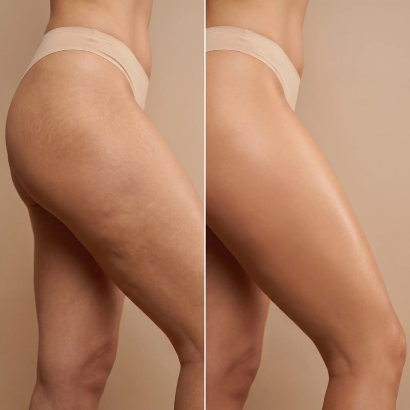Lymphdrainage